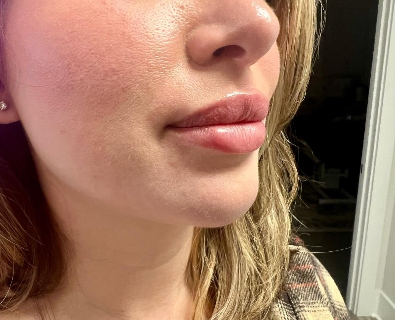 A woman with dermal filler in her lips