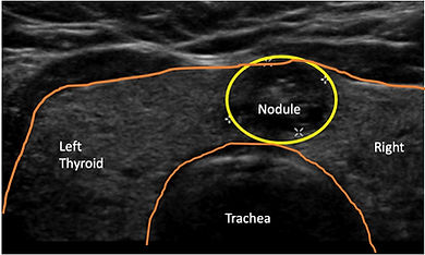 thyroid nodule