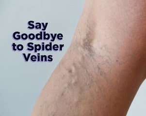 A graphic that reads, 'Say Goodbye to Spider Veins'