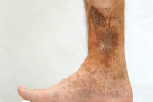 A lower leg and ankle with venous ulcers