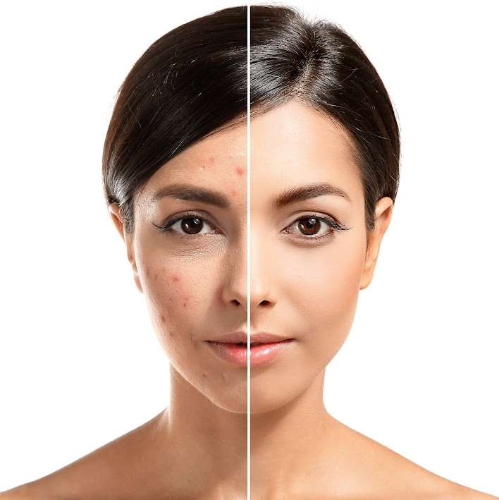 A before-and-after image of a woman who has had Hyfrecation treatment