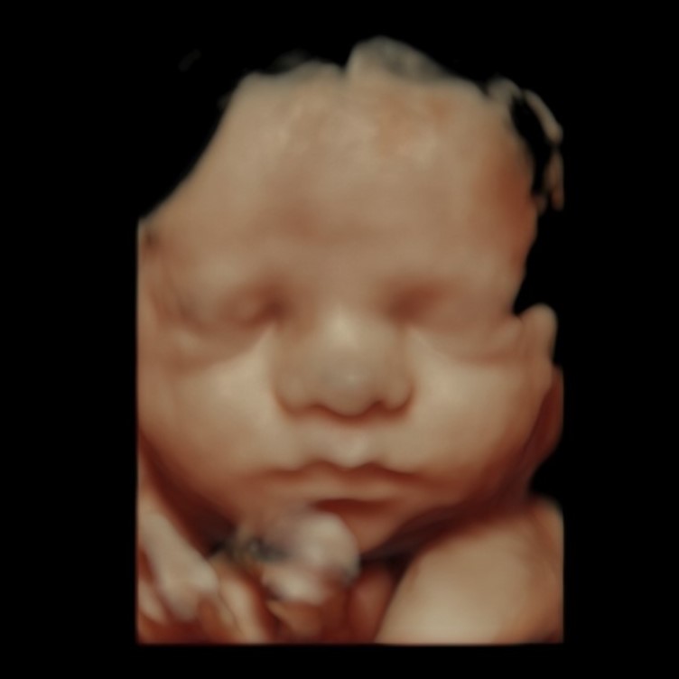 3D Ultrasound showing baby's face in tans and pinks
