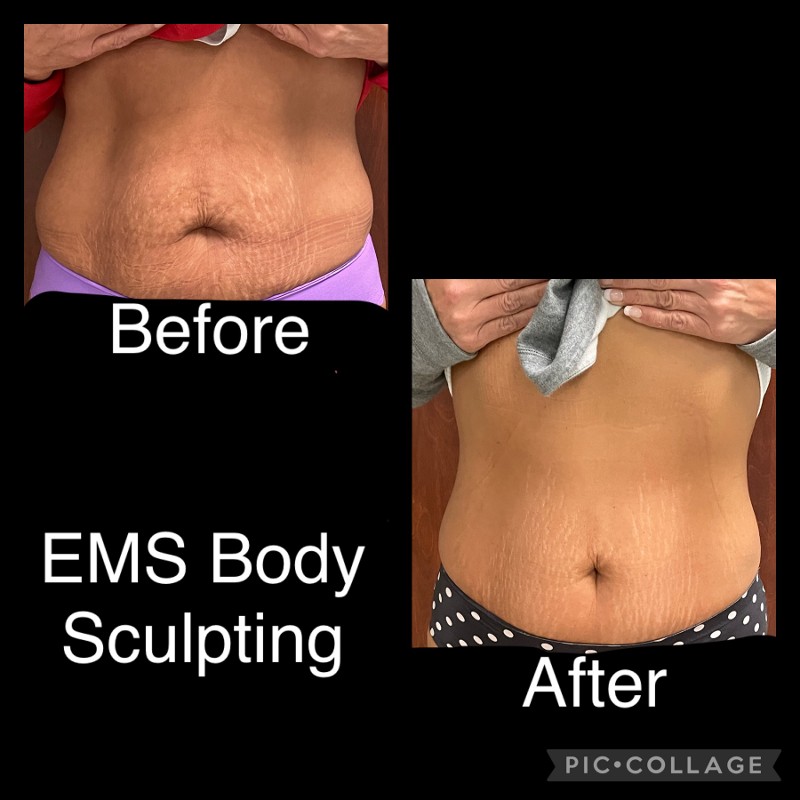 ems body sculpting before and after