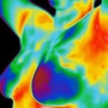 Breast thermography scan.