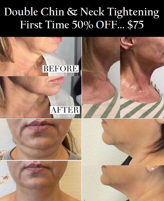 Neck & Jowl - Double Chin & Skin Tining - FIRST-TIME CLIENT SALE - $99