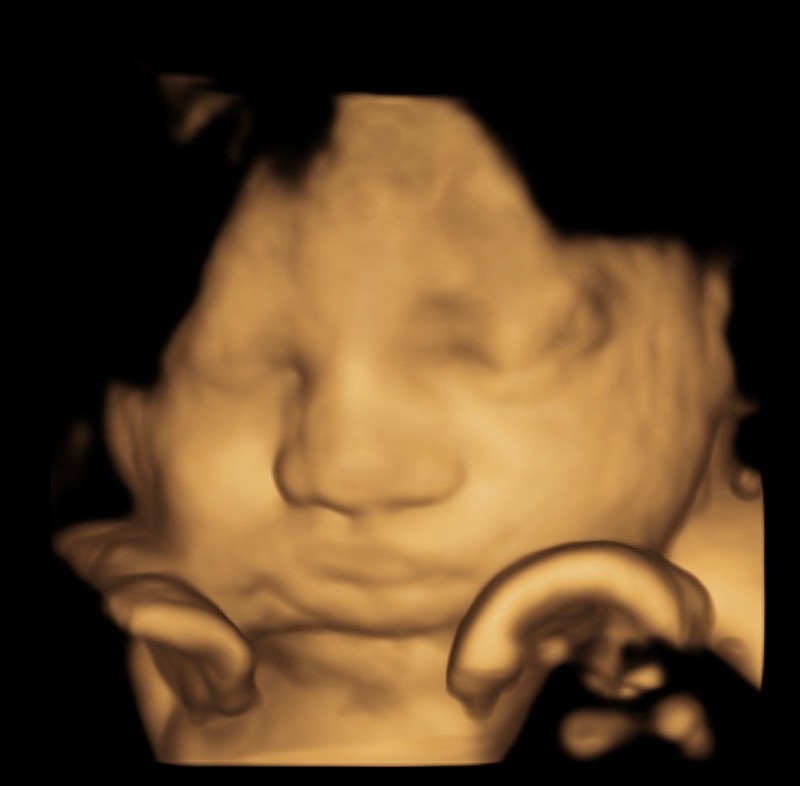 3D Ultrasound image shows baby's face in tans and pinks