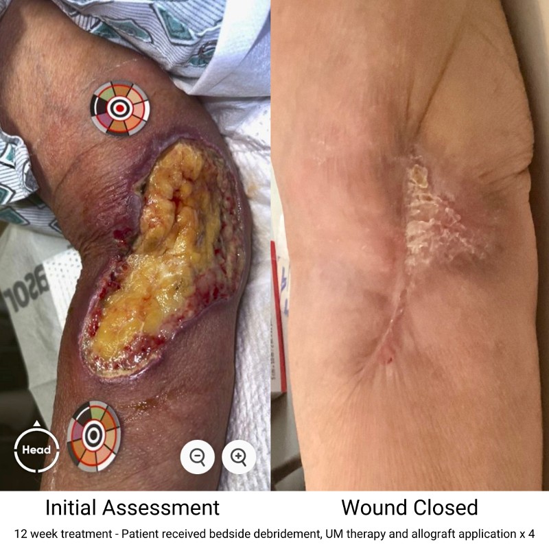 Before and after photos a bedside debridement wound closure.