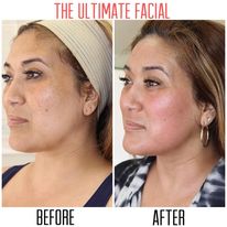 before and after facial treatment photo