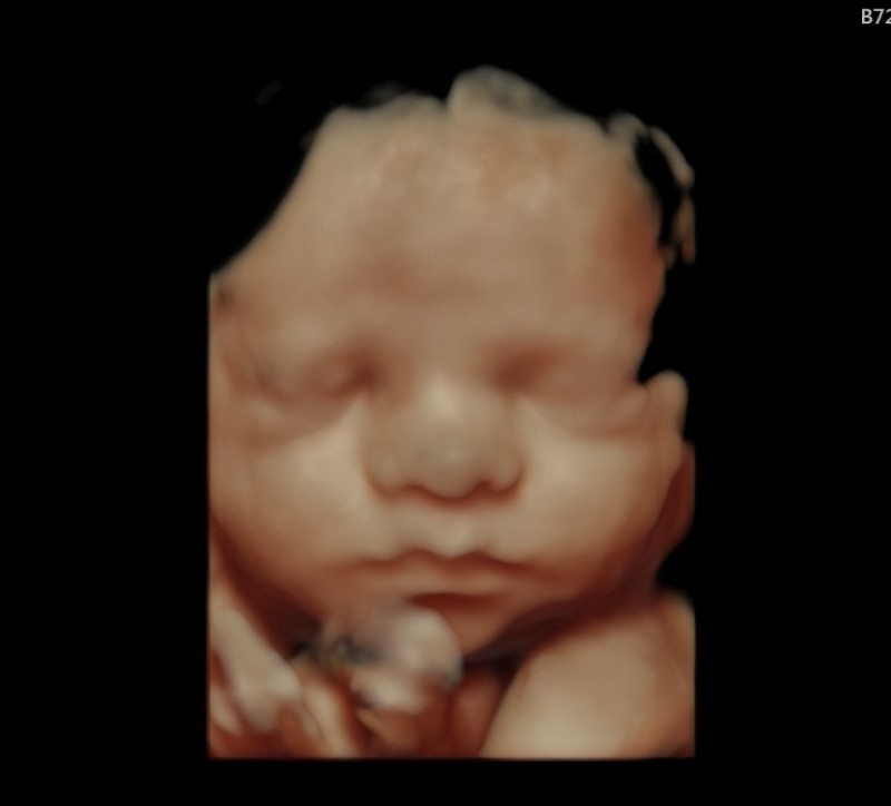 4D Ultrasound render shows higher-detail image of baby