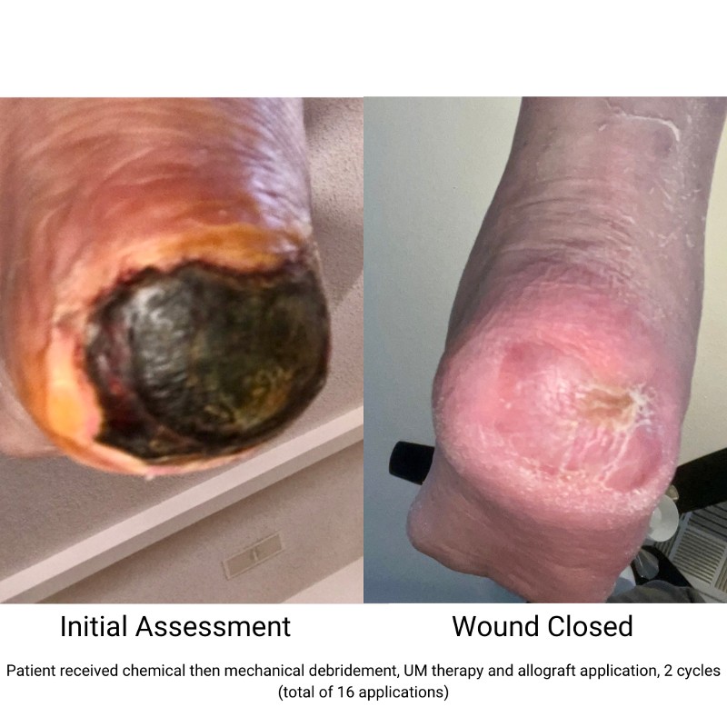 Before and after photos of chemical and mechanical debridement, UM therapy, and allograft application to an amputation.