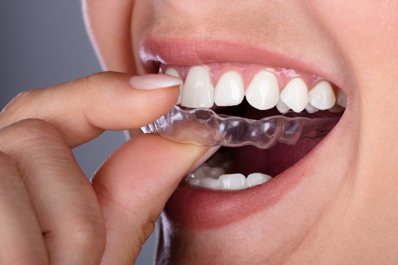 A lady applies an aligner.