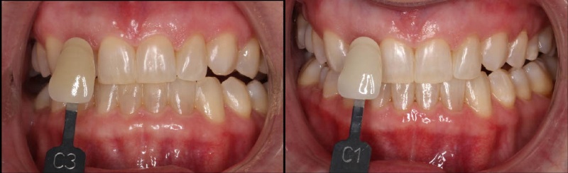 Teeth before and after laser whitening