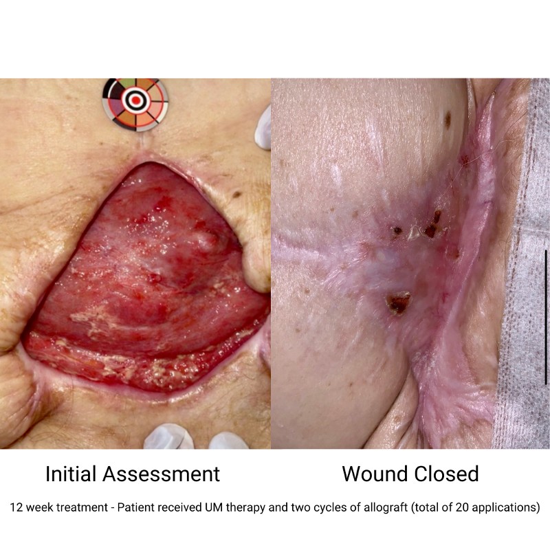 Before and after photos of UM therapy and allograft treatment of an open wound. 