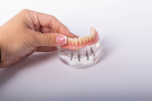 All-On-4 Implants