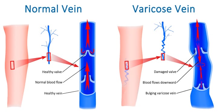 Image showing a normal vein versus a varicose vein