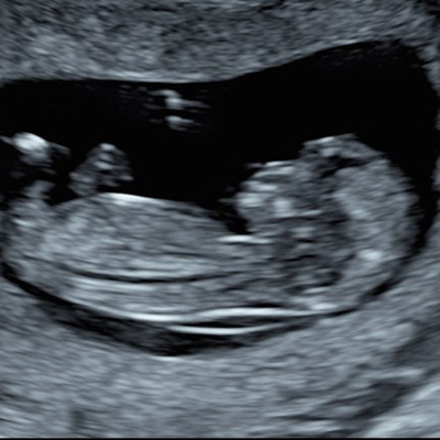 2D Ultrasound image in standard grayscale