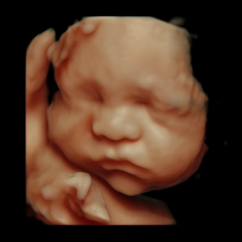 Higher resolution 5D Ultrasound showing baby's face in tans and pinks