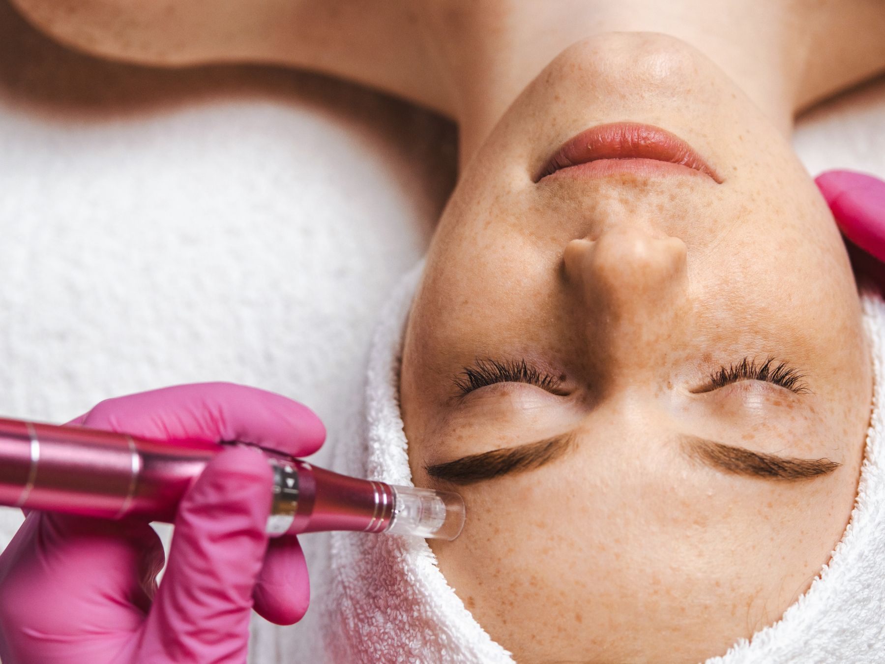 SkinPen Microneedling