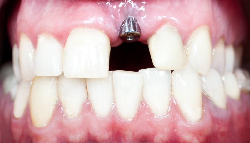 Dental implants installed in Denver, CO.
