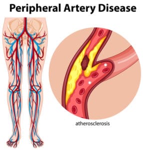 A graphic showing an example of peripheral arterial disease