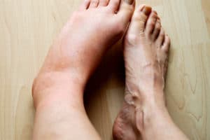 An image of two feet, one of which is swollen due to lymphedema