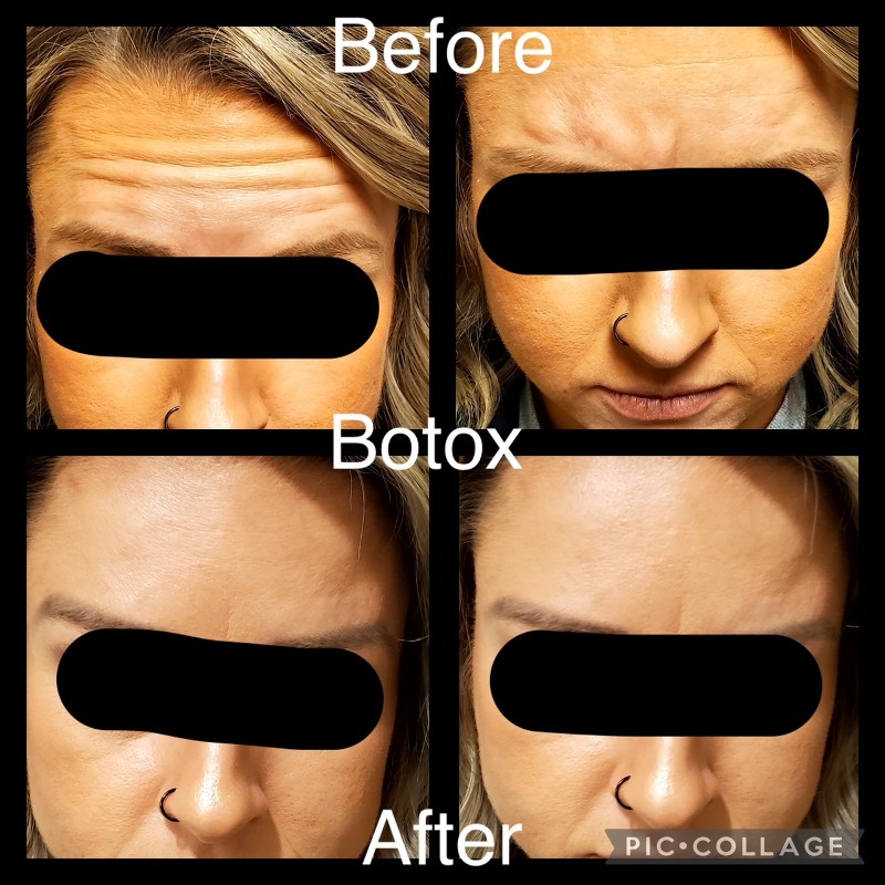 botox before and after