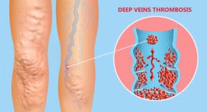 A graphic showing deep vein thrombosis